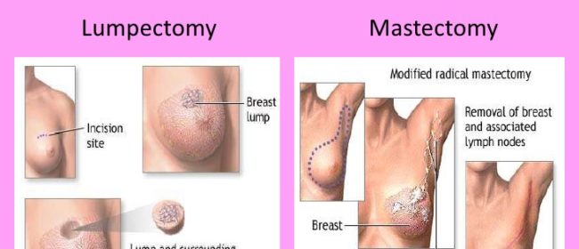 What Is Breast Cancer Lumpectomy?