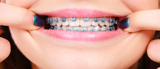 5 Things To Expect After You Get Braces